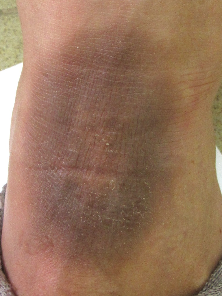 Случай №4. Фиксированная эритема… или не всякая эритема красная. | Сайт ...