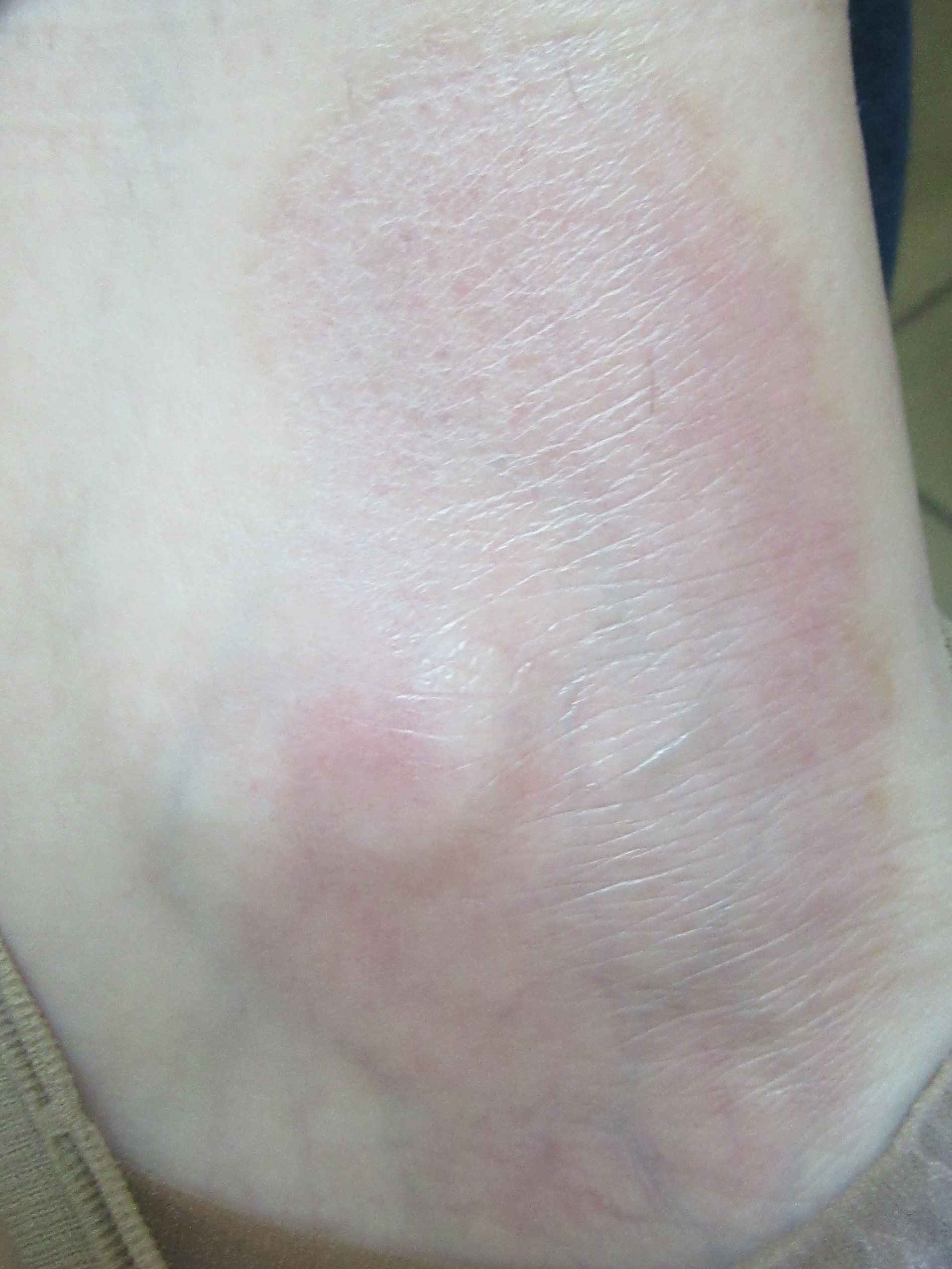 Простой хронический лишай Видаля. Информация для специалистов. | Сайт ...