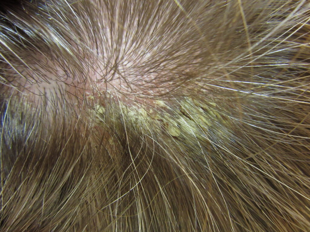 Стригущий лишай волосистой части головы | Клиника «Консилиум»